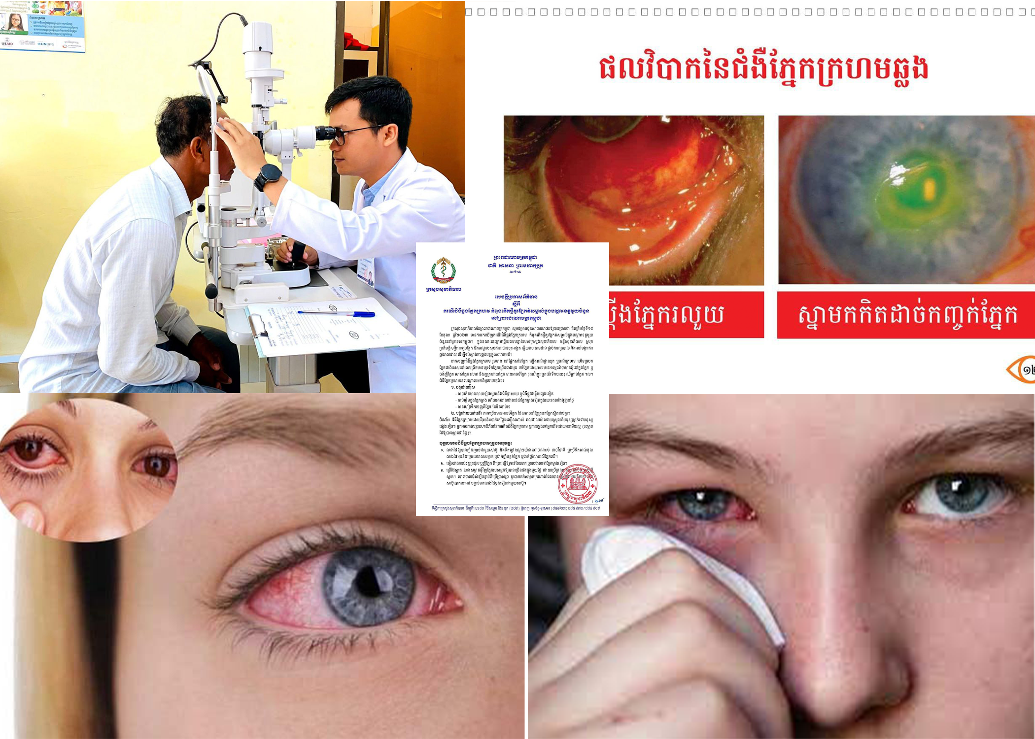 សូមប្រុងប្រយ័ត្ន! «ករណីជំងឺឆ្លងភ្នែកក្រហមកំពុងកើតថ្មីគួរឱ្យកត់សម្គាល់ក្នុងបណ្តាខេត្តមួយចំនួននៅព្រះរាជាណាចក្រកម្ពុជា»